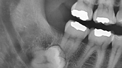 치과의사도 기도하게 만드는 X-레이 짤