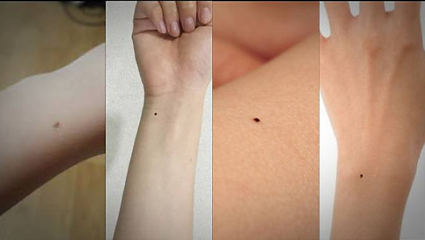 여자들은 전부 손목에 까만 점이 있다는데 사실일까?